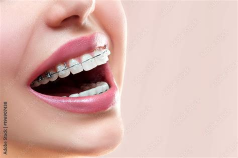 metal brackets dental|metal braces for teeth alignment.